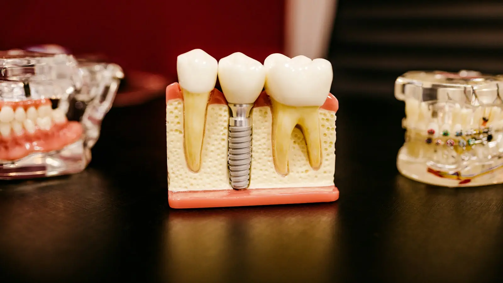 A dental implant model between natural teeth
