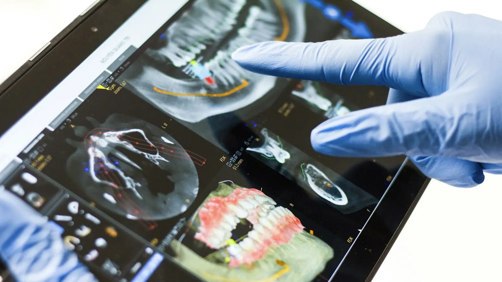 A gloved hand pointing at a 3D dental scan on a tablet