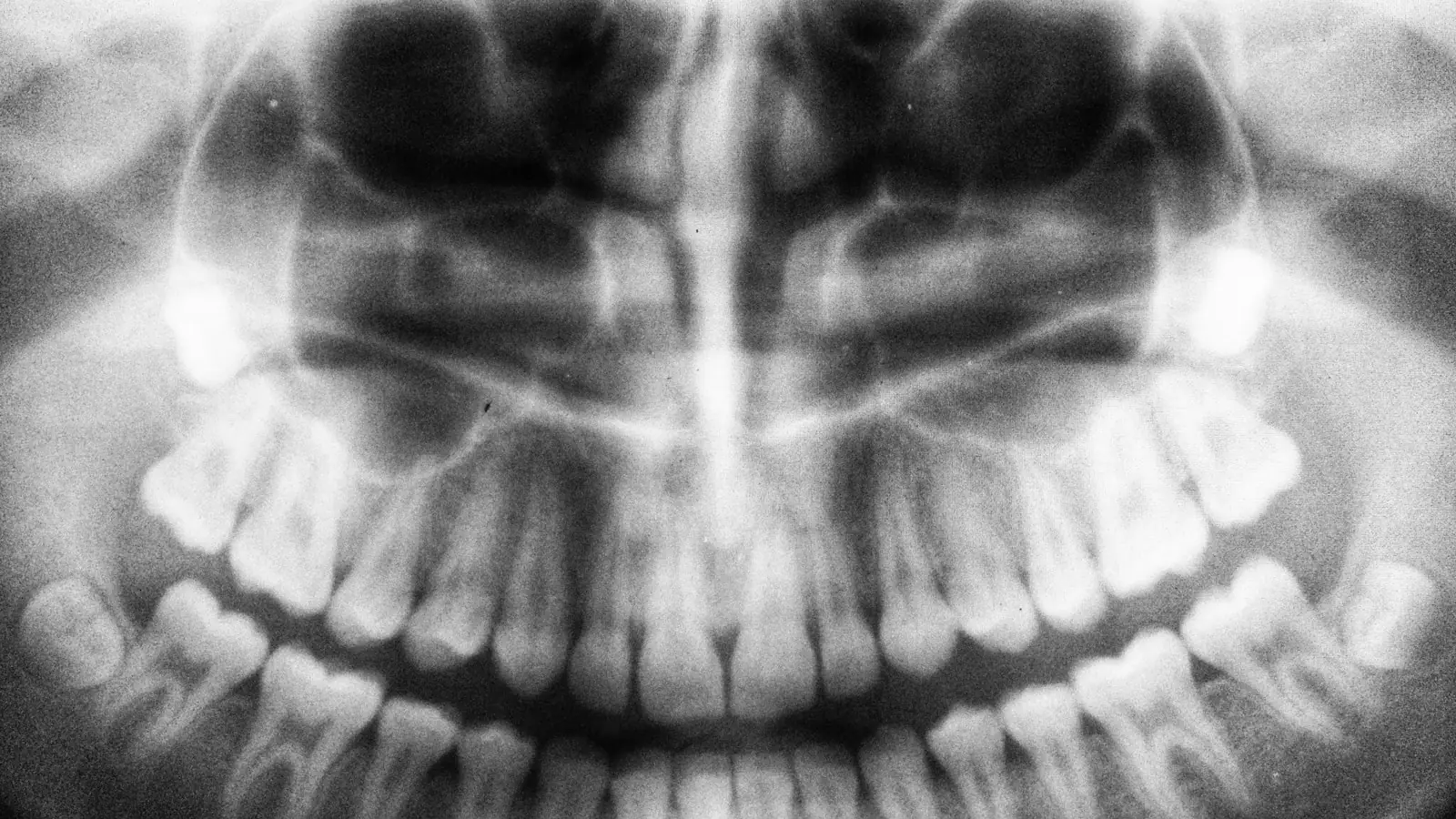 A panoramic dental X-ray (OPG) of both jaws